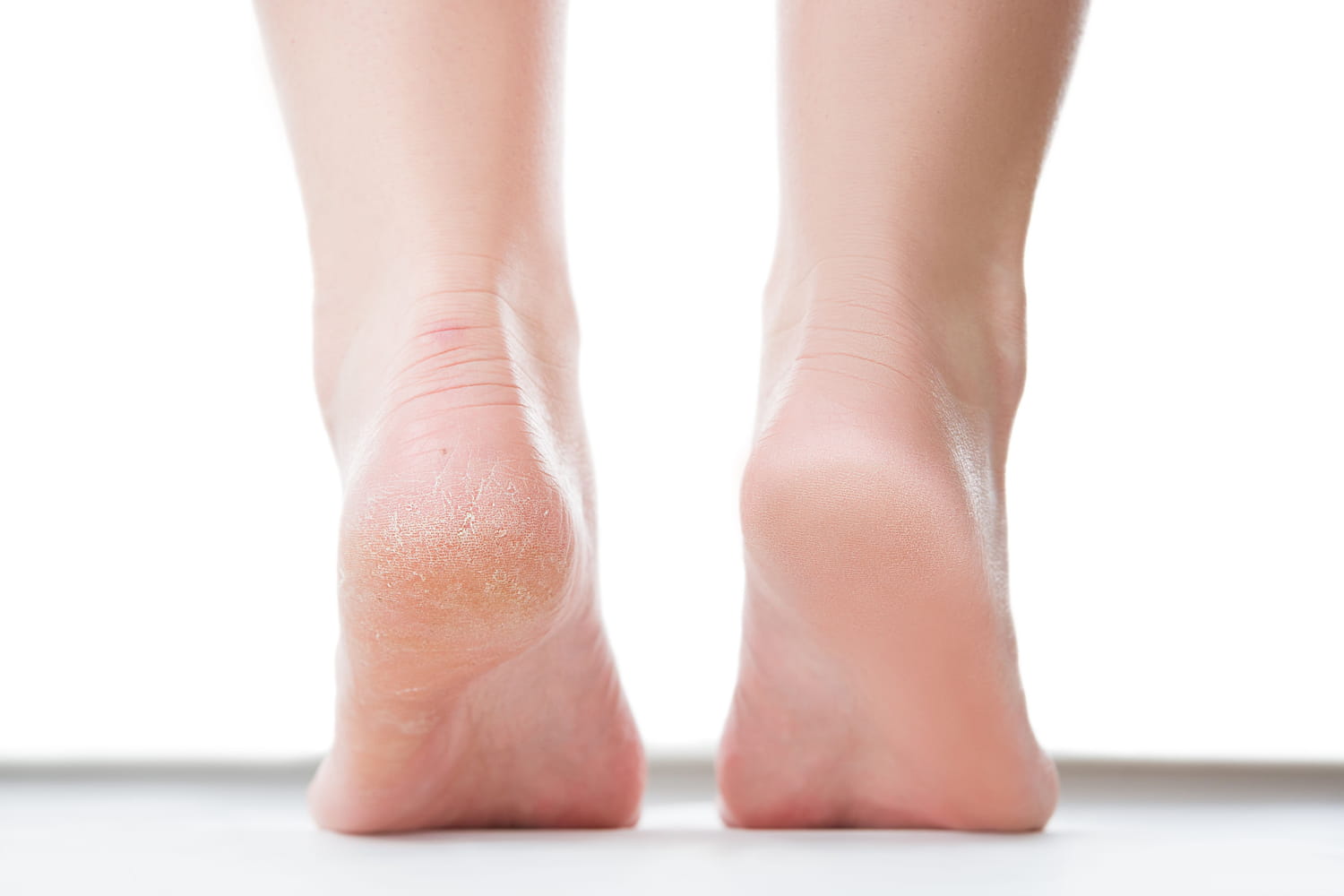 Fissures du pied, du talon, de la main : comment traiter ?