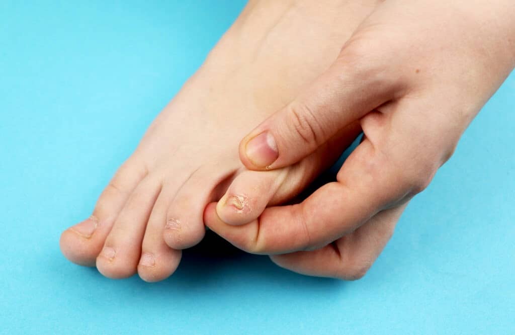 Ongle de petit orteil épais : causes et traitements