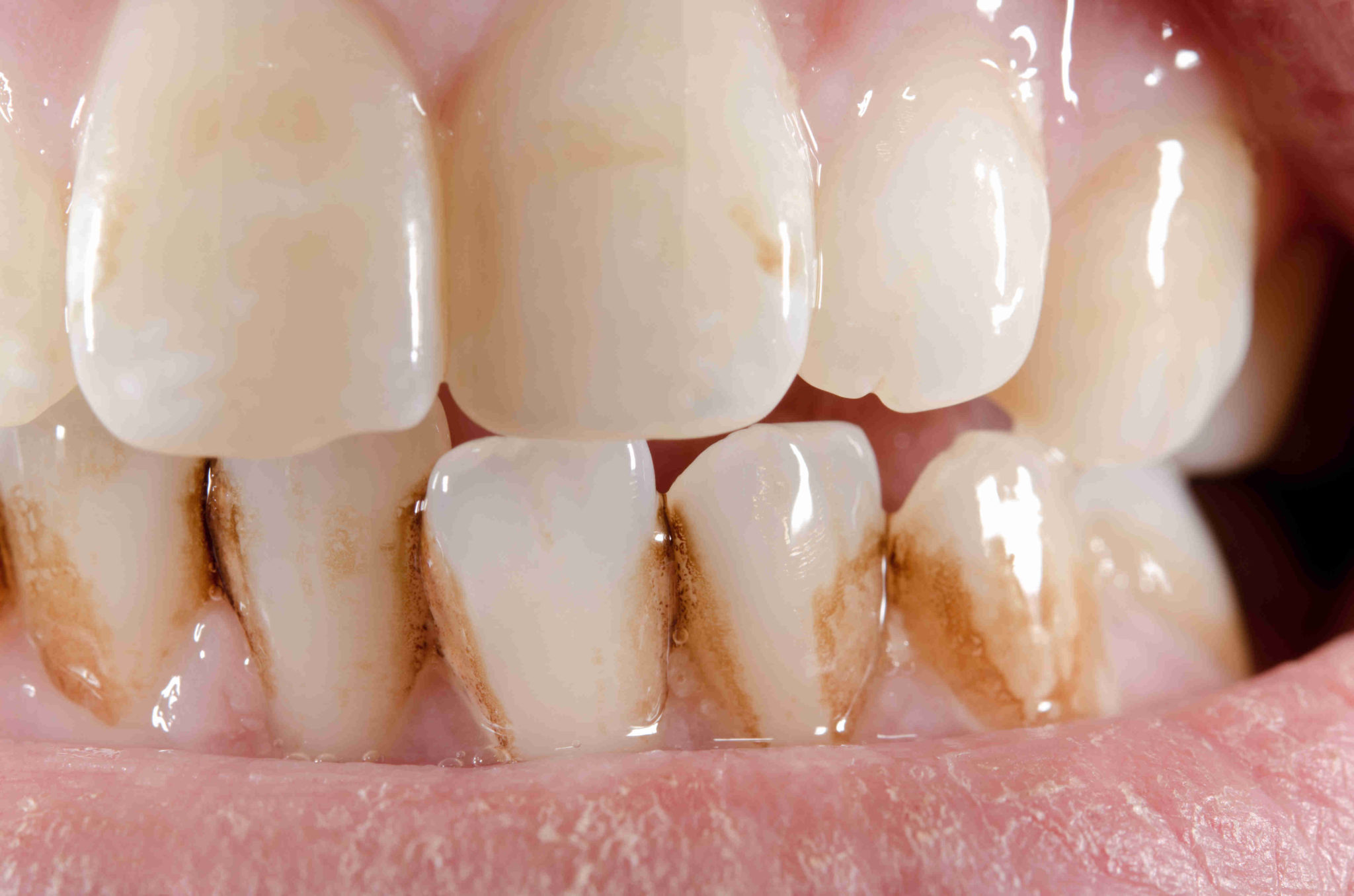 Taches brunes sur les dents : prévention et solutions