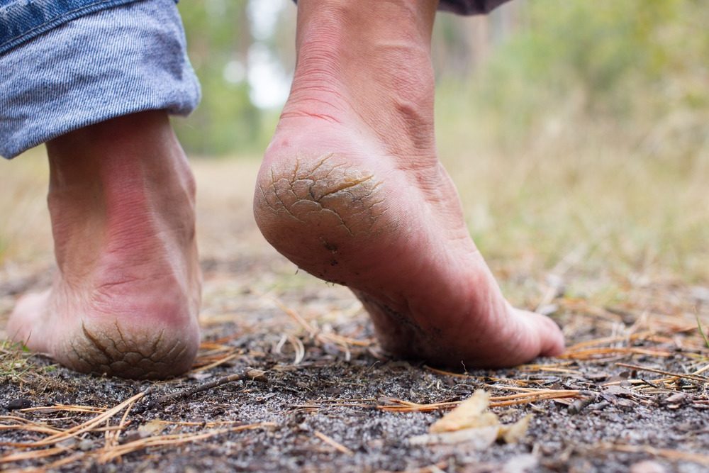 Talons fissurés : causes, symptômes et traitement