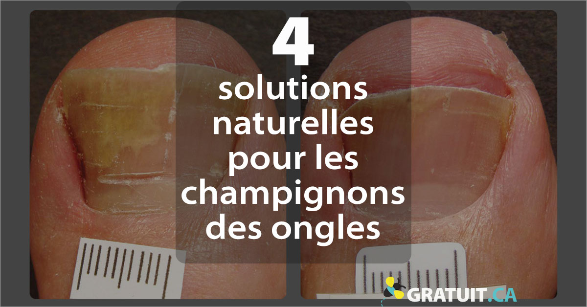 4 solutions naturelles pour traiter l'onychomycose (champignon des ongles)